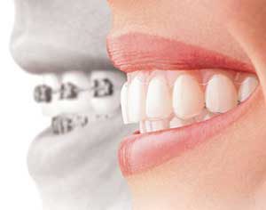 Invisalign Treatment - Orthodontist Pleasant Hill, CA 94523